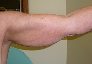Brachioplasty (arm lift)