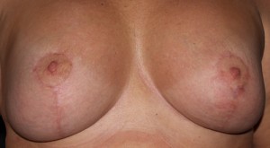 Breast Augmentation Mastopexy with Implants