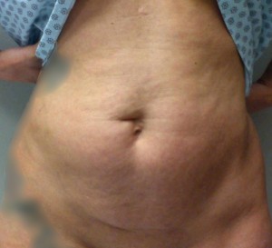 Abdominoplasty Results Kansas City