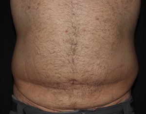 Abdominoplasty with and without Liposuction