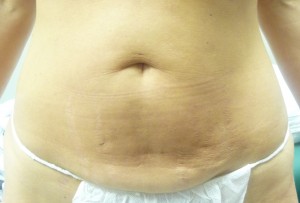 Abdominoplasty (tummy tuck)