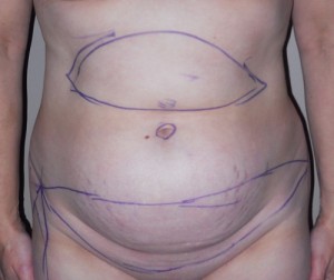 Abdominoplasty with and without Liposuction