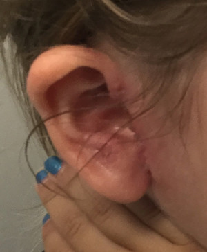 Otoplasty (Ear Pinning)