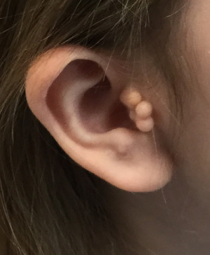 Otoplasty (Ear Pinning)