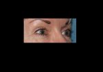 Blepharoplasty (upper and/or lower eyelids)