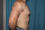 Gynecomastia with and without Liposuction