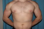 Gynecomastia with and without Liposuction