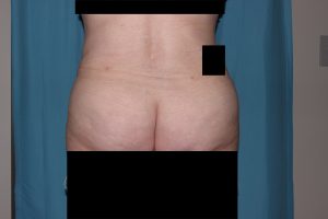 Abdominoplasty with Liposuction (hips, waist, back bra rolls)