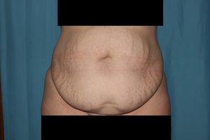 Abdominoplasty with Liposuction (hips, waist, back bra rolls)